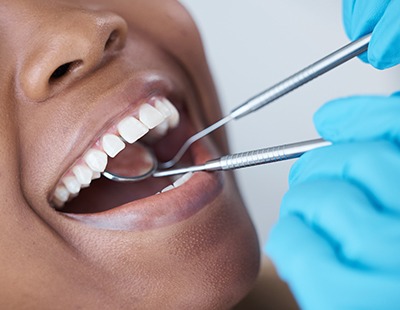 closeup of a patient’s open mouth with dental tools in it