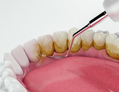 illustration of teeth being cleaned