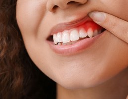 A woman revealing her inflamed gums