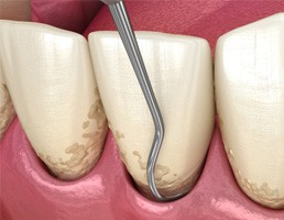 A 3D illustration of a scaling and root planing treatment