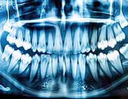 Dental X-ray showing impacted wisdom teeth