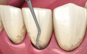 Illustration of scaler being used to clean tooth roots